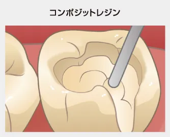 コンポジットレジン