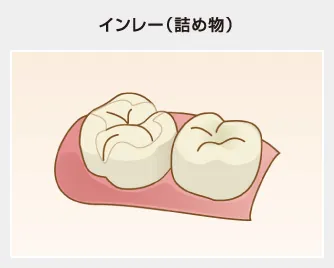 インレー（詰め物）
