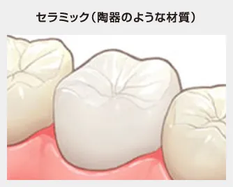 セラミック（陶器のような材質）