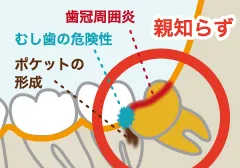 斜めに生えて７番の歯を圧迫している