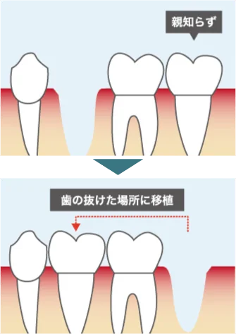 歯の移植（自家歯牙移植）